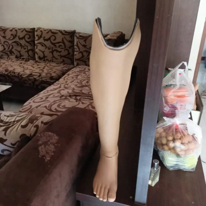 Mengalami lutut kaku pasca amputasi? Kenali penyebab, risiko luka, dan solusi latihan agar Anda sukses memakai kaki palsu bawah lutut.