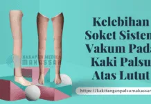 Soket Kaki Palsu Atas Lutut Model Vakum: Keunggulan & Cara Pembuatan KELEBIHAN SOKET SISTEM VAKUM PADA KAKI PALSU ATAS LUTUT
