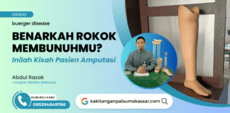 BENARKAH ROKOK MEMBUNUHMU? INILAH KISAH PASIEN AMPUTASI Buerger disease ini terjadi akibat pembuluh darah perifer yang mengalami sumbatan ke bagian ujung tungkai kaki sehingga nutrisi makanan dan oksigen sangat tidak mencukupi kebutuhannya yang tentu berakibat resiko kematian jaringan tubuh